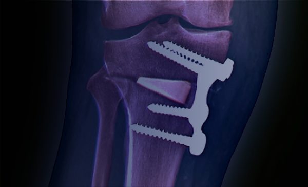 Knee Realignment Surgeries – Flex Knee And Shoulder Clinic